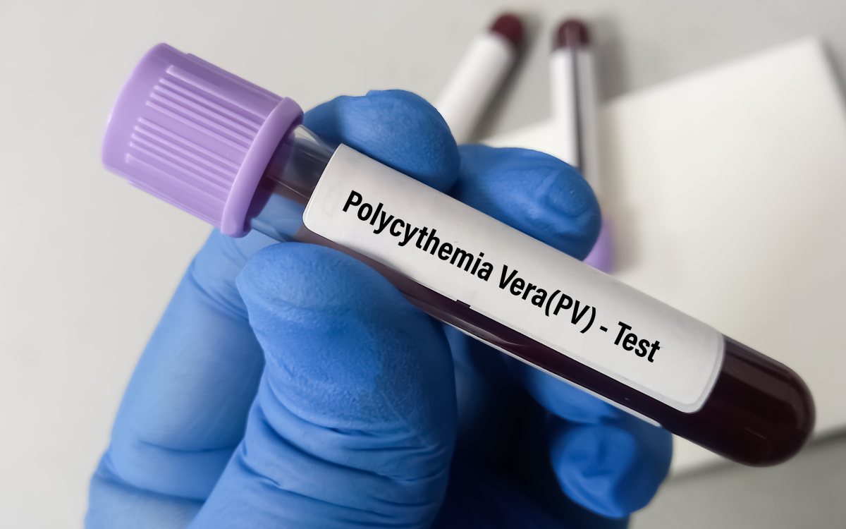 Polycythemia vera – Symptoms and risk factors