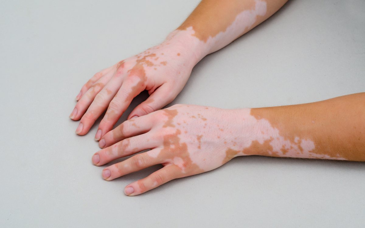 Vitiligo – Causes, symptoms, and management